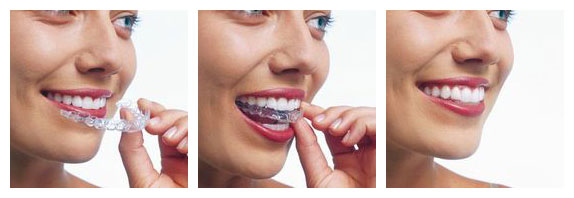 invisalign-diagram