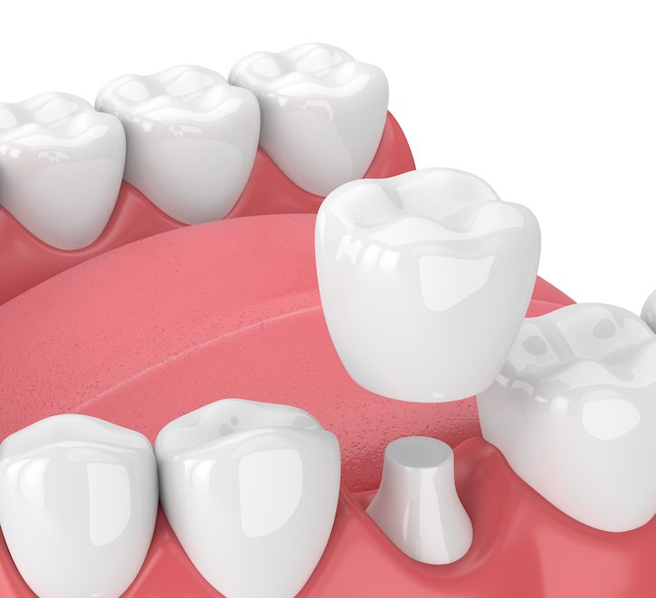 3d render of jaw with teeth and dental crown restoration