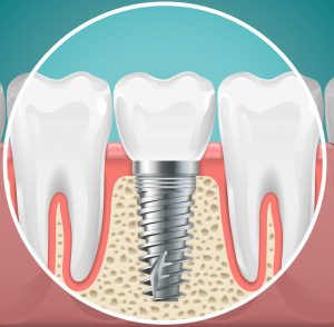 Image of inside the gum of a dental implant