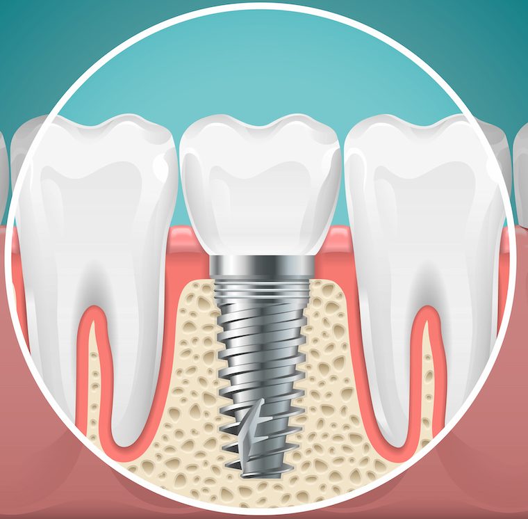 Stomatology illustrations. Dental implants and healthy teeth