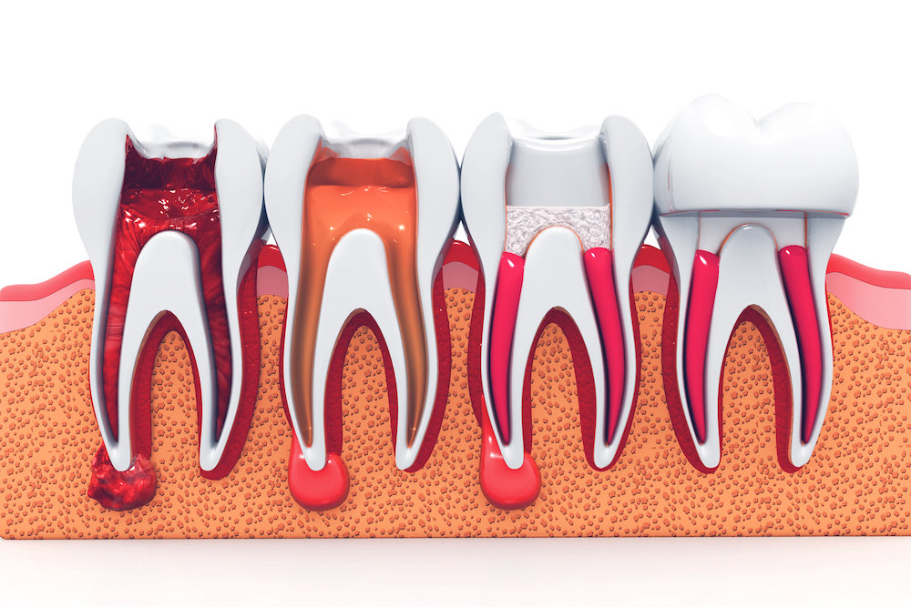 stages of root canal treatment