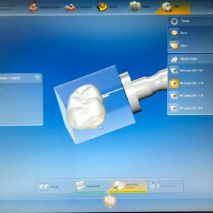 3D image of tooth from a scan